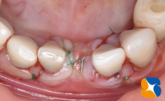東大阪　奈良　石切駅前　鈴木歯科　ブルーラジカル　静脈麻酔鎮静　寝ながらリラックス　歯周病　インプラント　失った骨の再生医療　血液コラーゲン　歯科用最新CT精度が高い　正確な診査と診断