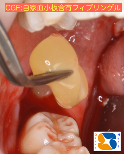 東大阪　奈良　石切駅前　鈴木歯科　ブルーラジカル　静脈麻酔鎮静　寝ながらリラックス　歯周病　インプラント　失った骨の再生医療　血液コラーゲン　歯科用最新CT精度が高い　正確な診査と診断