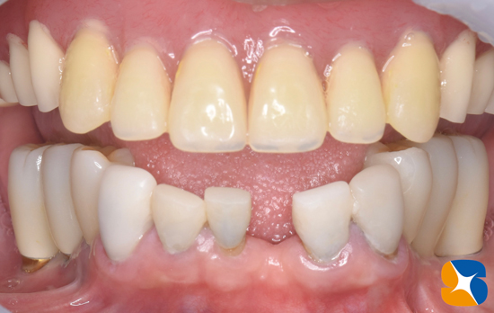 東大阪　奈良　石切駅前　鈴木歯科　ブルーラジカル　静脈麻酔鎮静　寝ながらリラックス　歯周病　インプラント　失った骨の再生医療　血液コラーゲン　歯科用最新CT精度が高い　正確な診査と診断