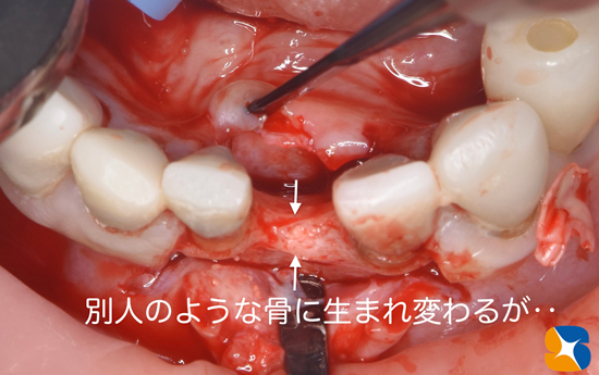 東大阪　奈良　石切駅前　鈴木歯科　ブルーラジカル　静脈麻酔鎮静　寝ながらリラックス　歯周病　インプラント　失った骨の再生医療　血液コラーゲン　歯科用最新CT精度が高い　正確な診査と診断