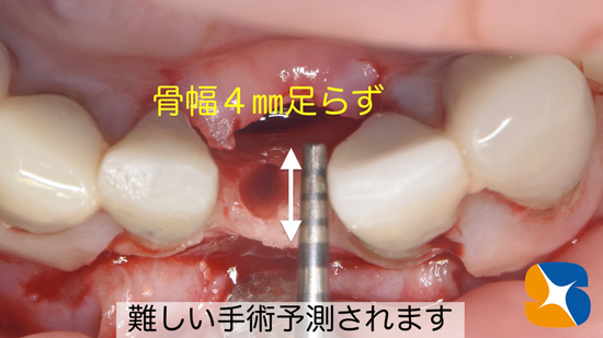 東大阪　奈良　石切駅前　鈴木歯科　ブルーラジカル　静脈麻酔鎮静　寝ながらリラックス　歯周病　インプラント　失った骨の再生医療　血液コラーゲン　歯科用最新CT精度が高い　正確な診査と診断