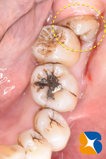 静脈点滴麻酔と難しい抜歯とドライソケット予防を保険でやってのける先生東大阪　奈良　石切駅前　鈴木歯科　ブルーラジカル　静脈麻酔鎮静　寝ながらリラックス　歯周病　インプラント　失った骨の再生医療　血液コラーゲン　歯科用最新CT精度が高い　正確な診査と診断