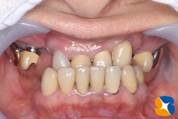 ナチュラル入れ歯　ノンクラスプ入れ歯　ヒューマン入れ歯　沈まない入れ歯　金具バネを隠す見えない入れ歯　鈴木歯科医院　石切駅前1分　問題点を解決した部分入れ歯