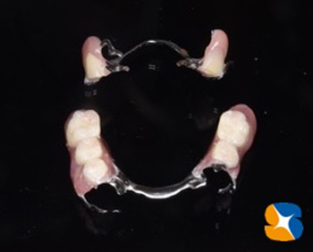 ナチュラル入れ歯　ノンクラスプ入れ歯　ヒューマン入れ歯　沈まない入れ歯　金具バネを隠す見えない入れ歯　鈴木歯科医院　石切駅前1分　問題点を解決した部分入れ歯