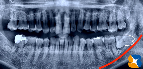 静脈点滴麻酔と難しい抜歯とドライソケット予防を保険でやってのける先生東大阪　奈良　石切駅前　鈴木歯科　ブルーラジカル　静脈麻酔鎮静　寝ながらリラックス　歯周病　インプラント　失った骨の再生医療　血液コラーゲン　歯科用最新CT精度が高い　正確な診査と診断