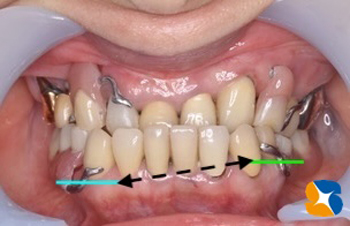 ナチュラル入れ歯　ノンクラスプ入れ歯　ヒューマン入れ歯　沈まない入れ歯　金具バネを隠す見えない入れ歯　鈴木歯科医院　石切駅前1分　問題点を解決した部分入れ歯