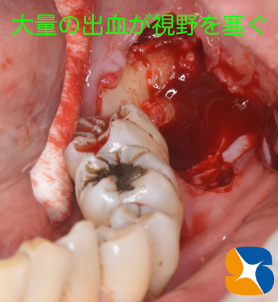 静脈点滴麻酔と難しい抜歯とドライソケット予防を保険でやってのける先生東大阪　奈良　石切駅前　鈴木歯科　ブルーラジカル　静脈麻酔鎮静　寝ながらリラックス　歯周病　インプラント　失った骨の再生医療　血液コラーゲン　歯科用最新CT精度が高い　正確な診査と診断