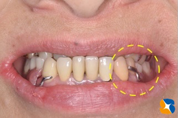 ナチュラル入れ歯　ノンクラスプ入れ歯　ヒューマン入れ歯　沈まない入れ歯　金具バネを隠す見えない入れ歯　鈴木歯科医院　石切駅前1分　問題点を解決した部分入れ歯