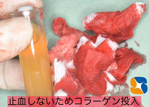 静脈点滴麻酔と難しい抜歯とドライソケット予防を保険でやってのける先生東大阪　奈良　石切駅前　鈴木歯科　ブルーラジカル　静脈麻酔鎮静　寝ながらリラックス　歯周病　インプラント　失った骨の再生医療　血液コラーゲン　歯科用最新CT精度が高い　正確な診査と診断