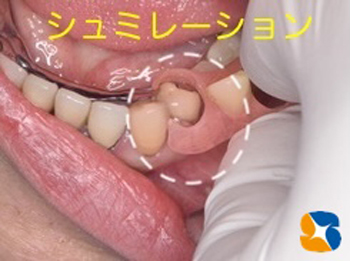 ナチュラル入れ歯　ノンクラスプ入れ歯　ヒューマン入れ歯　沈まない入れ歯　金具バネを隠す見えない入れ歯　鈴木歯科医院　石切駅前1分　問題点を解決した部分入れ歯