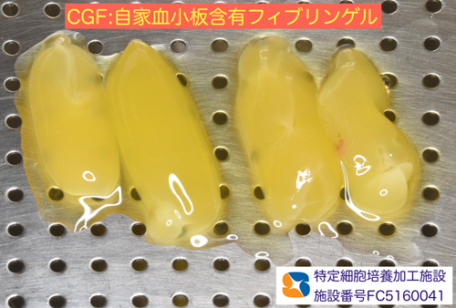 静脈点滴麻酔と難しい抜歯とドライソケット予防を保険でやってのける先生東大阪　奈良　石切駅前　鈴木歯科　ブルーラジカル　静脈麻酔鎮静　寝ながらリラックス　歯周病　インプラント　失った骨の再生医療　血液コラーゲン　歯科用最新CT精度が高い　正確な診査と診断