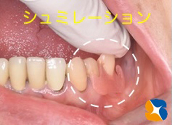 ナチュラル入れ歯　ノンクラスプ入れ歯　ヒューマン入れ歯　沈まない入れ歯　金具バネを隠す見えない入れ歯　鈴木歯科医院　石切駅前1分　問題点を解決した部分入れ歯