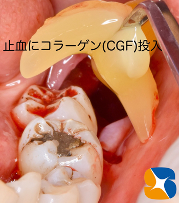 静脈点滴麻酔と難しい抜歯とドライソケット予防を保険でやってのける先生東大阪　奈良　石切駅前　鈴木歯科　ブルーラジカル　静脈麻酔鎮静　寝ながらリラックス　歯周病　インプラント　失った骨の再生医療　血液コラーゲン　歯科用最新CT精度が高い　正確な診査と診断