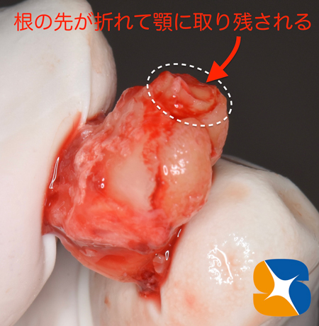 静脈点滴麻酔と難しい抜歯とドライソケット予防を保険でやってのける先生東大阪　奈良　石切駅前　鈴木歯科　ブルーラジカル　静脈麻酔鎮静　寝ながらリラックス　歯周病　インプラント　失った骨の再生医療　血液コラーゲン　歯科用最新CT精度が高い　正確な診査と診断