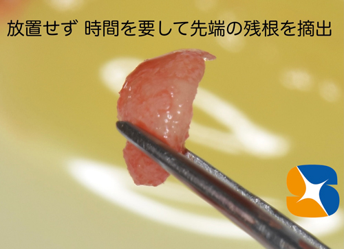 静脈点滴麻酔と難しい抜歯とドライソケット予防を保険でやってのける先生東大阪　奈良　石切駅前　鈴木歯科　ブルーラジカル　静脈麻酔鎮静　寝ながらリラックス　歯周病　インプラント　失った骨の再生医療　血液コラーゲン　歯科用最新CT精度が高い　正確な診査と診断