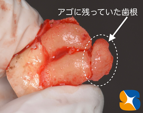 静脈点滴麻酔と難しい抜歯とドライソケット予防を保険でやってのける先生東大阪　奈良　石切駅前　鈴木歯科　ブルーラジカル　静脈麻酔鎮静　寝ながらリラックス　歯周病　インプラント　失った骨の再生医療　血液コラーゲン　歯科用最新CT精度が高い　正確な診査と診断