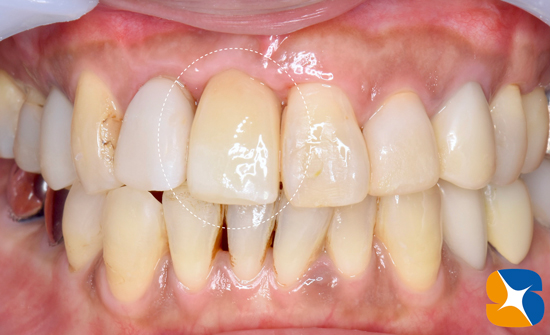 奈良・生駒・東大阪の鈴木歯科医院　寝ながら睡眠安心インプラント無料セット　静脈麻酔専門　歯医者　怖い　骨の再生医療