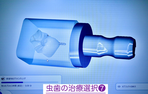 奈良・東大阪石切の鈴木歯科医院　親知らず難抜歯　保険で静脈麻酔治療専門　歯医者　怖い　寝ながら睡眠治療　ブルーラジカル専門