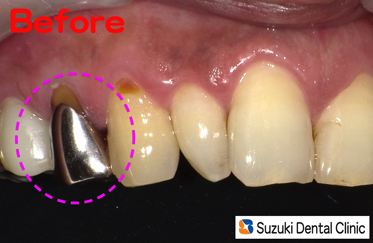 最新治療で奥歯は保険で白い歯