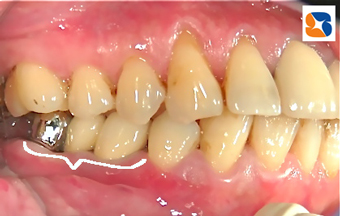 1/2残したので入れ歯は回避