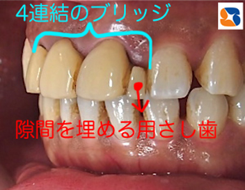 気になって口を開けて笑えない