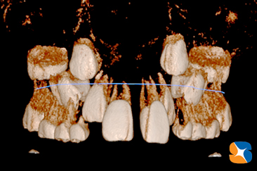 最新３D画像で歯並びを予測
