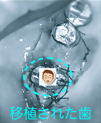 移植インプラント