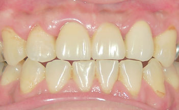 保険で仕上げた３連結のブリッジ