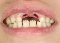 抜いた直後のお口