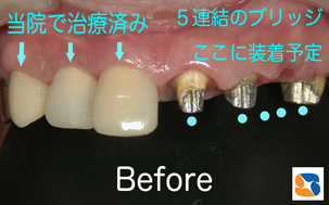 入れ歯から連結ブリッジへ