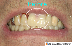 旧入れ歯の現状