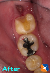 抜歯と虫歯の治療