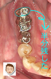 最善を尽くして奥歯を残した