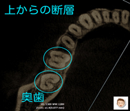 歯を輪切りにして診断