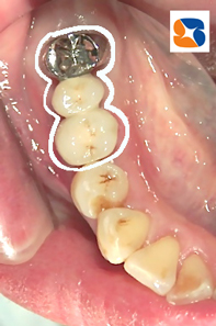 あきらめない！３連結のブリッジ