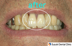 鈴木式快適入れ歯