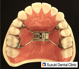 上のアゴを広げる矯正装置