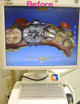 セレックで歯を読み込む