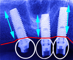 ３本のインプラントをレントゲン撮影