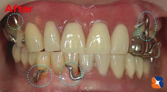 残せる歯をきちんと治療してから入れ歯で完成