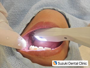 上の奥歯の虫歯　ビデオチェック