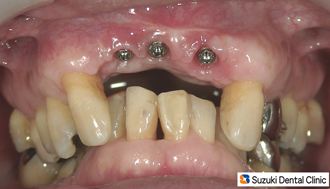 インプラントを埋め込む