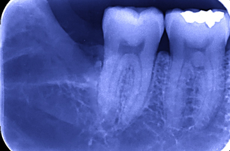 抜歯あとのレントゲン