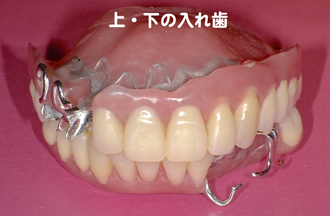 鈴木歯科医院のプレミアム入れ歯