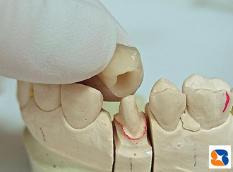 80,000円のオールセラミック