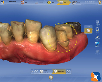 CAD(セレック）に入力