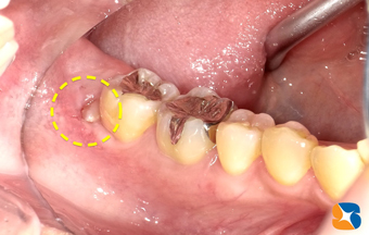 少しだけ頭を覗かせる親知らず