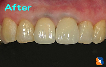 調和のとれた自然な前歯に変える