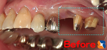 ３連結のブリッジ予定
