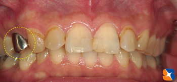 ２年前までは保険では銀歯しか出来なかった